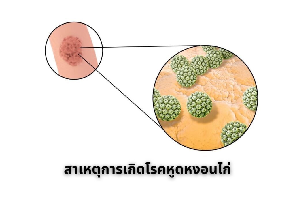 สาเหตุการเกิดโรคหูดหงอนไก่